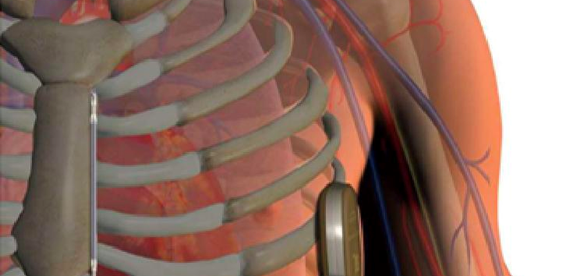 Στο American Medical Centre η πρώτη επέμβαση εμφύτευσης υποδόριου απινιδωτή στην Κύπρο